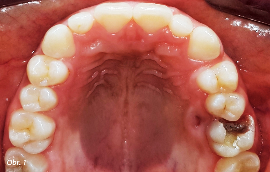 Kariézní léze v zubu 26.