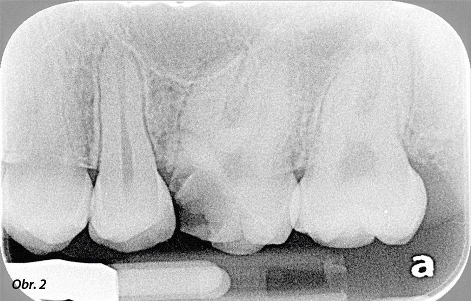 Počáteční ortográdní radiologické vyšetření.