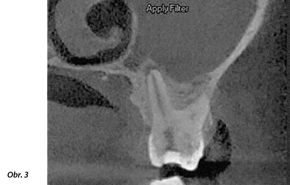 CBCT 5 × 5 – axiální pohled, kde lze pozorovat zvětšení objemu sliznice v oblasti maxilárního sinu a nosní skořepy (mukositida), stejně jako ztrátu kontinuity u dna maxilárního sinu.