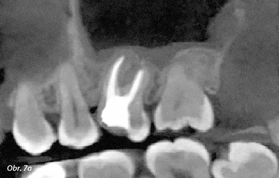 CBCT 5 × 5 – kontrolní vyšetření po 3 měsících ukazuje ztenčení antrálních sliznic i obnovu kosti.