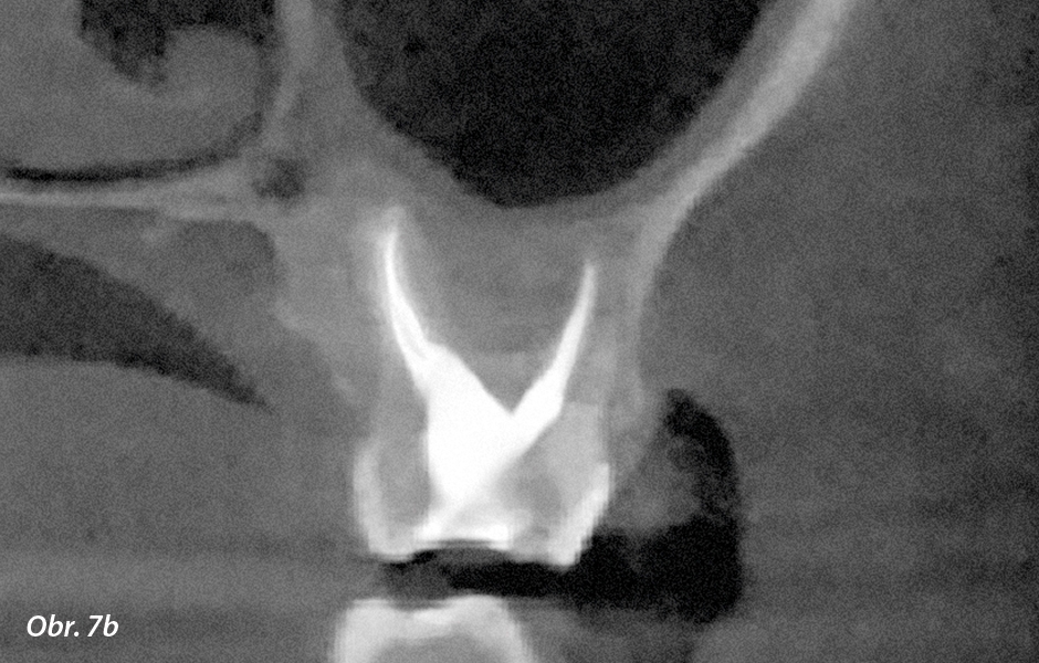 CBCT 5 × 5 – kontrolní vyšetření po 3 měsících ukazuje ztenčení antrálních sliznic i obnovu kosti.