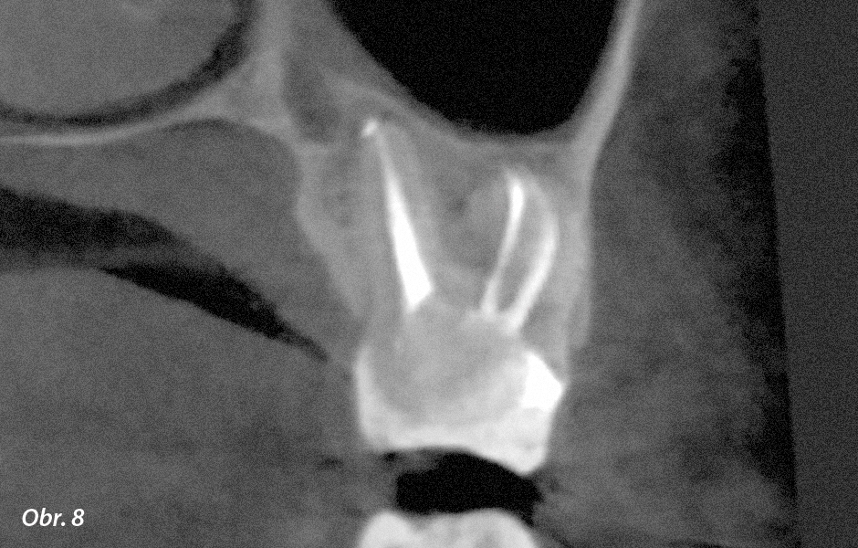 CBCT 5 × 5 – kontrolní vyšetření po 8 měsících – pacientka zůstává asymptomatická.