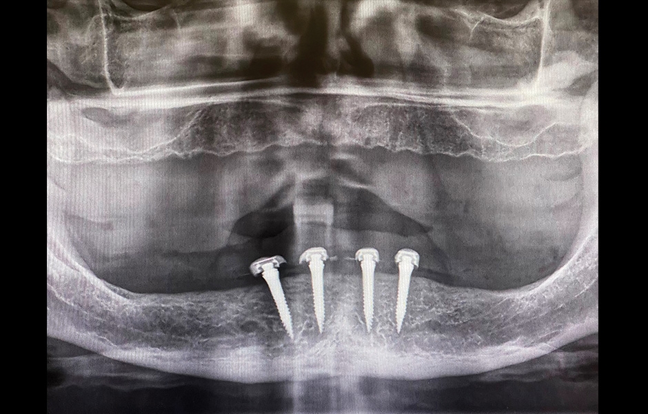 Obr. 15–16: Kontrola po čtyřech měsících: panoramatický RTG snímek a klinická fotografie.
