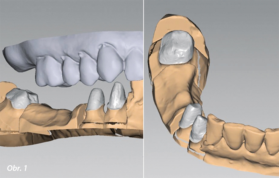 Počáteční situace s preparovanými pilíři v oblastech zubů 43, 44 a 47