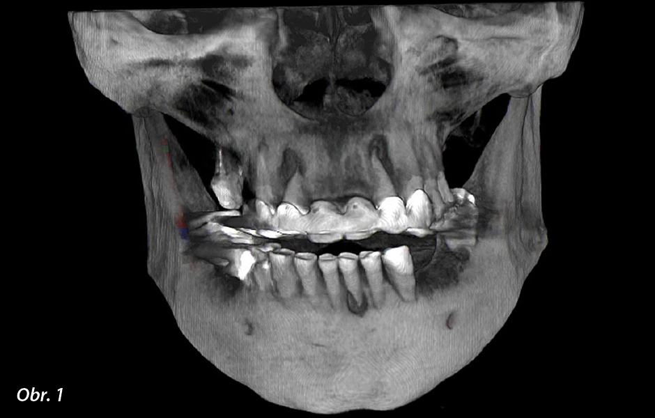 3D zobrazovací metody dostupné díky současné technologii CBCT jsou zásadní pro správnou diagnostiku a plánování ošetření