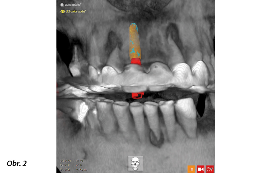 Interaktivní software plánování ošetření, jako je R2GATE, pomáhá lékaři identifikovat potenciální receptorové oblasti pro implantáty a umožňuje realistické simulace umístění implantátů