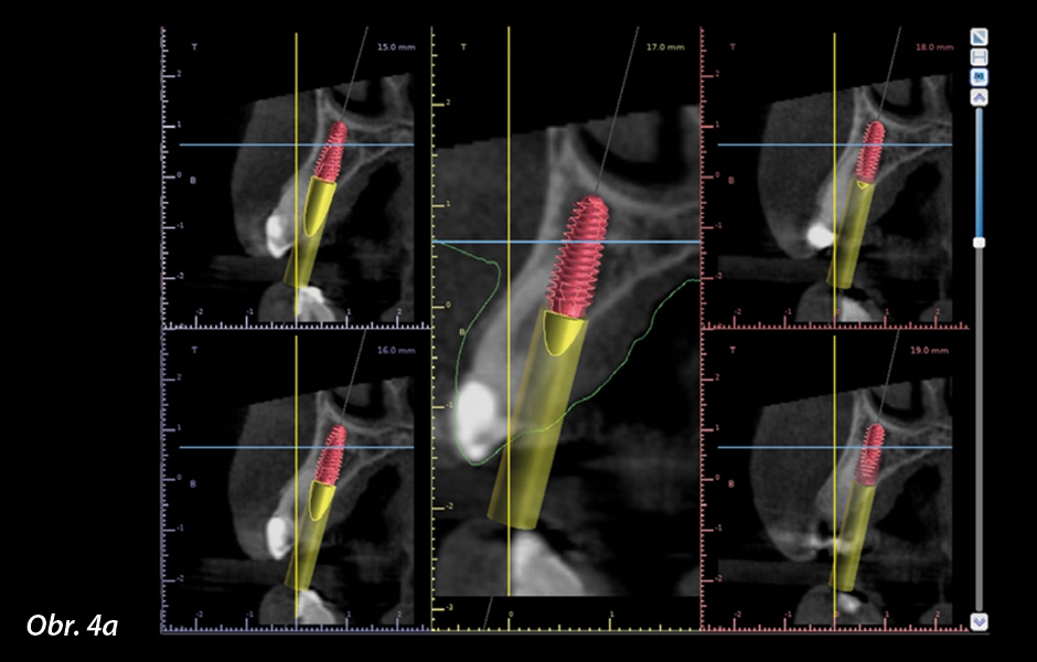 Nejprve byly identifikovány receptorové oblasti pro implantáty a virtuální implantáty umístěny do příčných řezů