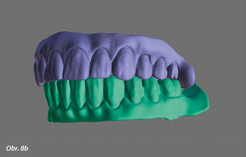 K dokončení procesu plánování byl z důvodu snahy o dosažení zavedení implantátu plně naváděného protetickými potřebami vytvořen na 3D povrchových datech DICOM diagnostický wax-up nebo virtuální set-up zubů pro zamýšlenou náhradu.