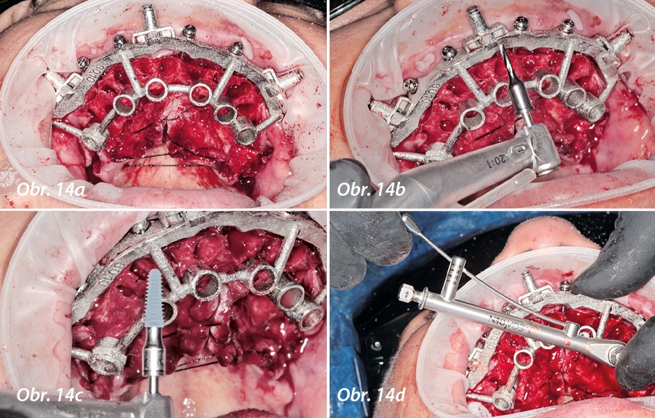 Chirurgická šablona pro osteotomii byla nasazena na fixační základnu a zajištěna zámky Swiss Locks
