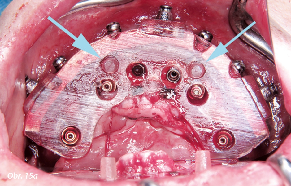 Druhým účelem přenosové šablony byla pomoc při naváděném umístění složených abutmentů skrze předem připravené otvory a na jednotlivé implantáty.