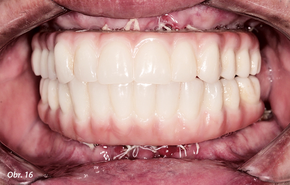 Provizorní náhrada v horní a dolní čelisti (dokončené v téže návštěvě) byla pacientovi odevzdána s minimálními úpravami okluze (ROE Dental Laboratory)