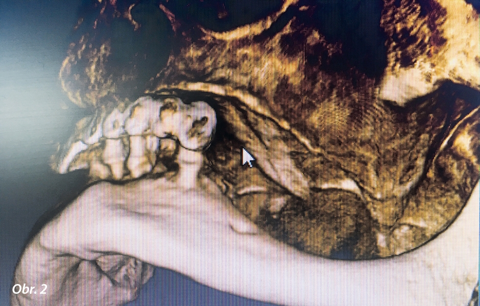 3D snímek zobrazující atrofi i alveolární části maxily a palatum planum