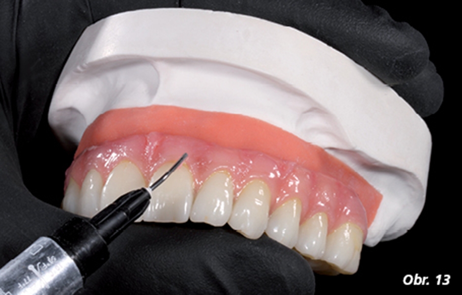 A byla navrstvena a vyleštěna gingivální část náhrady (Gingiva-Composites)