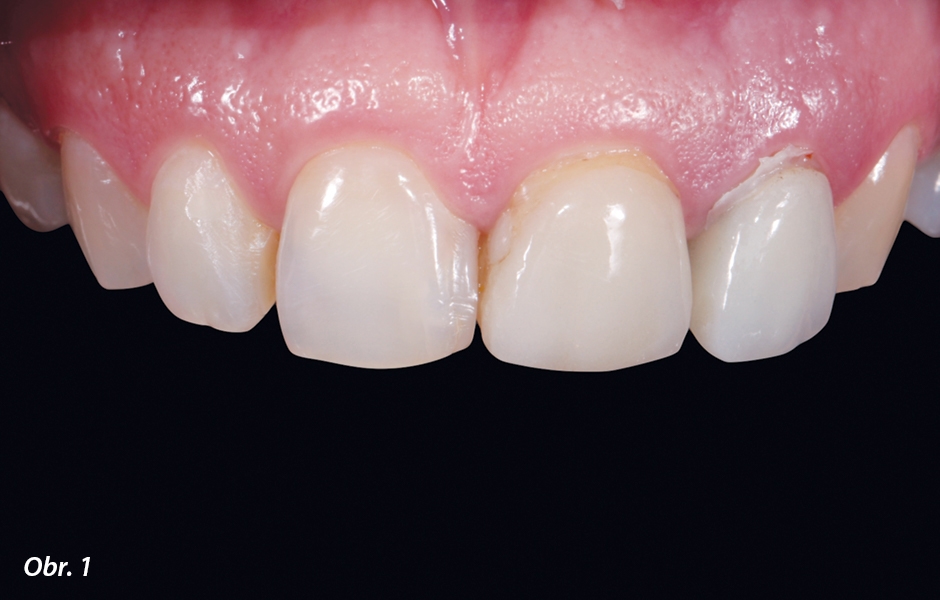 Počáteční klinická situace: nevyhovující náhrady na zubech 21 a 22 a nehezký úsměv pacienta