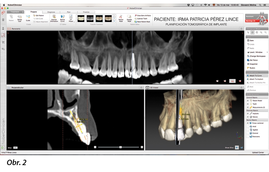 CT sken ukazuje nutnost okamžité extrakce zubu 22 a jeho rekonstrukce pomocí implantátu a následného nasazení provizorní náhrady