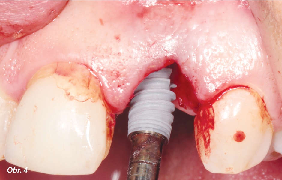 Okamžité zavedení implantátu po extrakci zubu