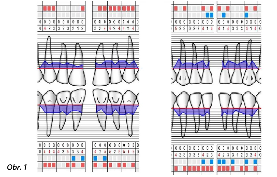  Případ 1 – Počáteční parodontologická tabulka. Zaznamenané parametry ve vyšetřovaných oblastech: dolní a horní frontální zuby (PPD, GR, BoP, PI).