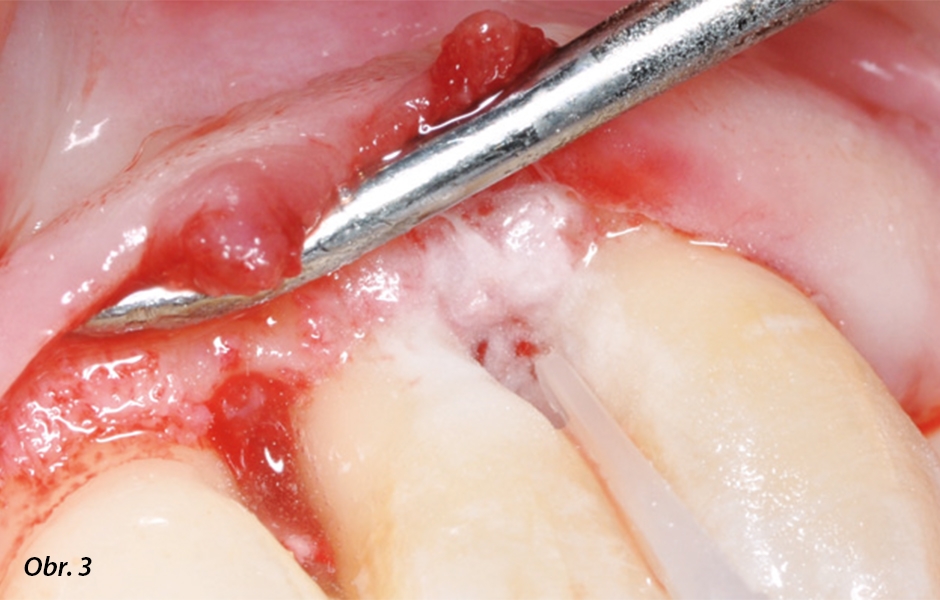 Ošetření povrchu kořene zubu 23 po debridementu