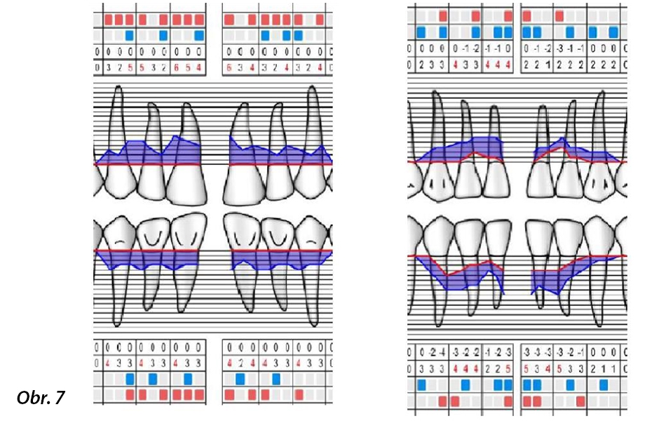 Případ 2 – Počáteční parodontologická tabulka – zaznamenané parametry ve vyšetřovaných oblastech: dolní a horní frontální zuby (PPD, GR, BoP, PI).