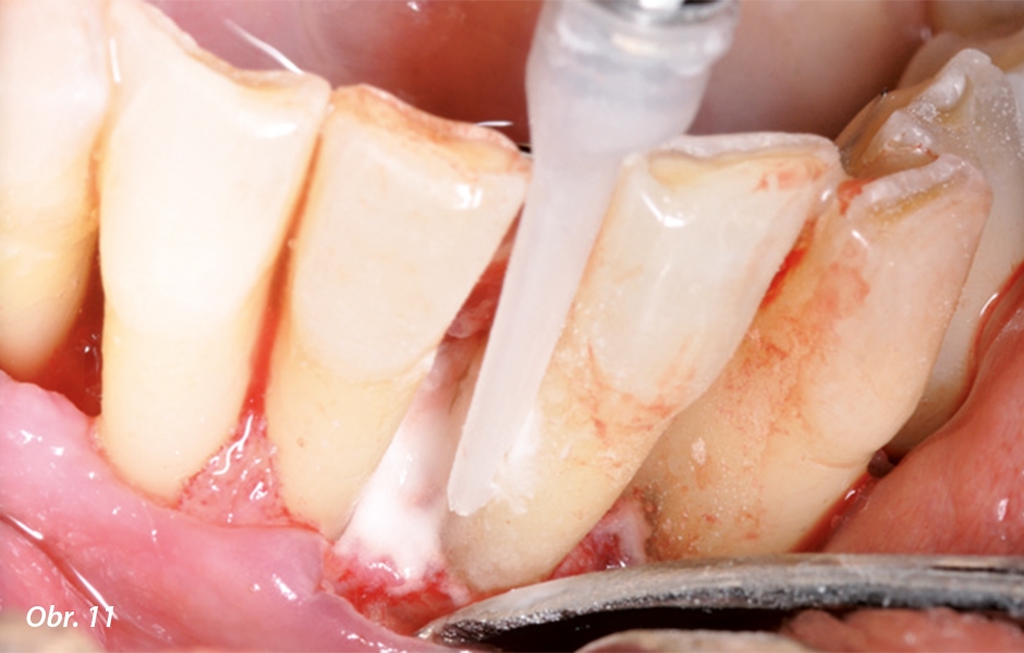 Ošetření kořenů dolních frontálních zubů po debridementu