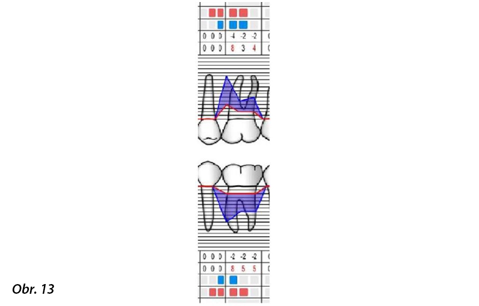 Případ 3 – Počáteční parodontologická tabulka – zaznamenané parametry ve vyšetřovaných oblastech: dolní levý první molár (PPD, GR, BoP, PI)