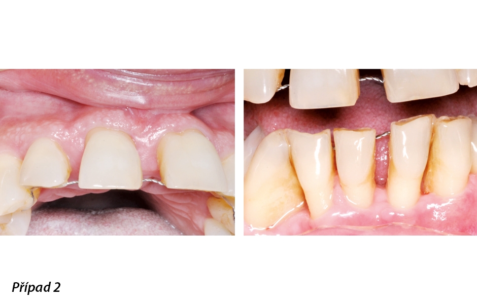 Funkce profylaktického pískovače během otevřené lalokové operace při resekční a regenerativní parodontologické léčbě