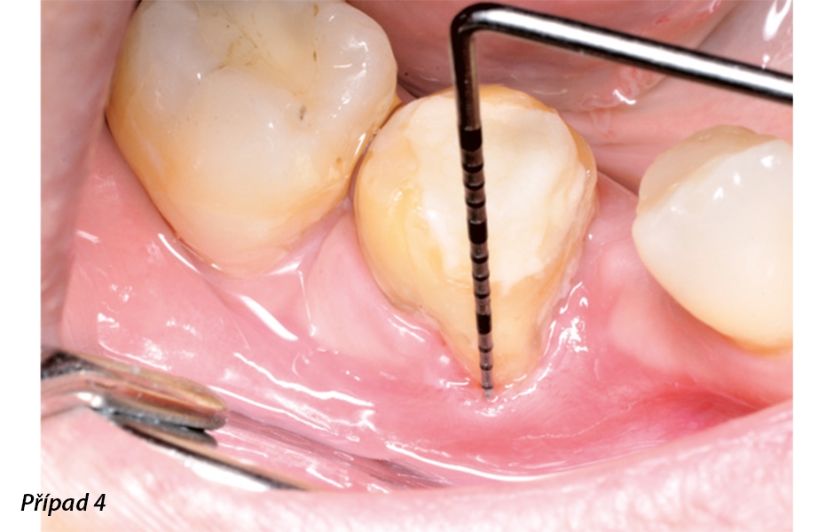 Funkce profylaktického pískovače během otevřené lalokové operace při resekční a regenerativní parodontologické léčbě