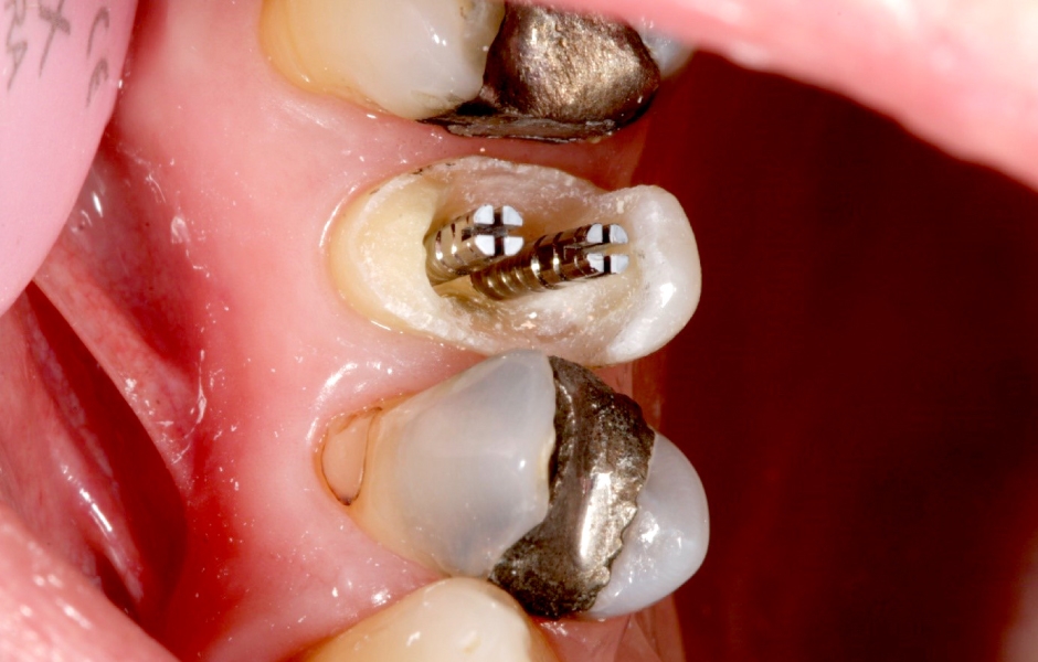 Obr. 10: Po endodontickém ošetření zubu 25 – zavedení titanových čepů Unimetric do bukálního a palatinálního kanálku.