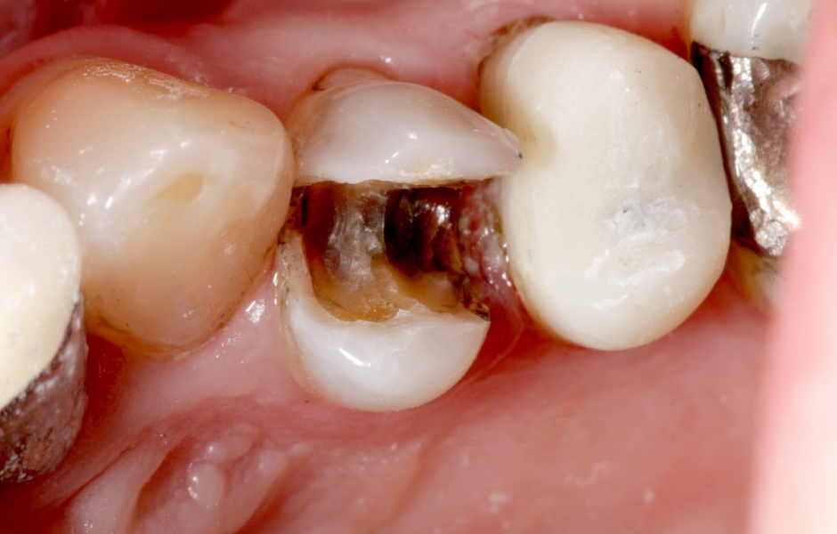 Obr. 13 a, b: Zub 24, rozsáhlý defekt tvrdých tkání zubu MOD.