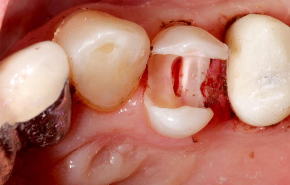 Obr. 13 a, b: Zub 24, rozsáhlý defekt tvrdých tkání zubu MOD.