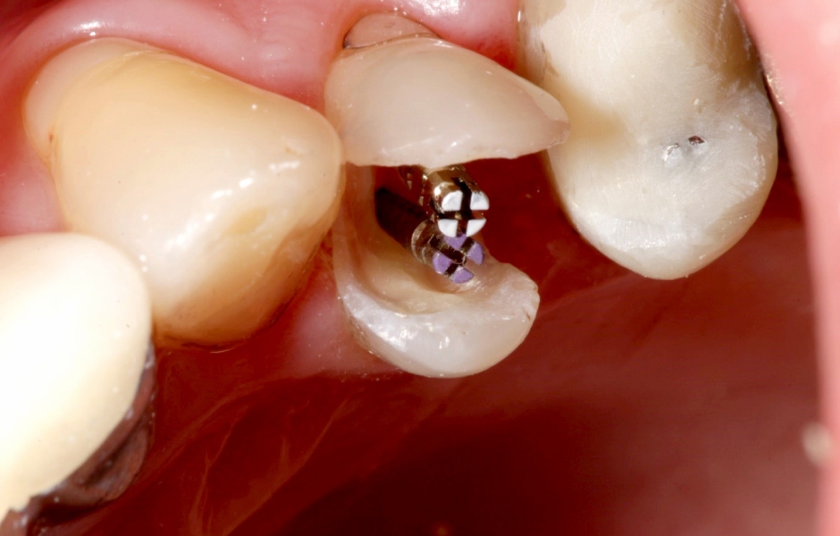 Obr. 14: Po endodontickém ošetření zubu 24 – zavedení titanových čepů Unimetric do palatinálního a bukálního kanálku.
