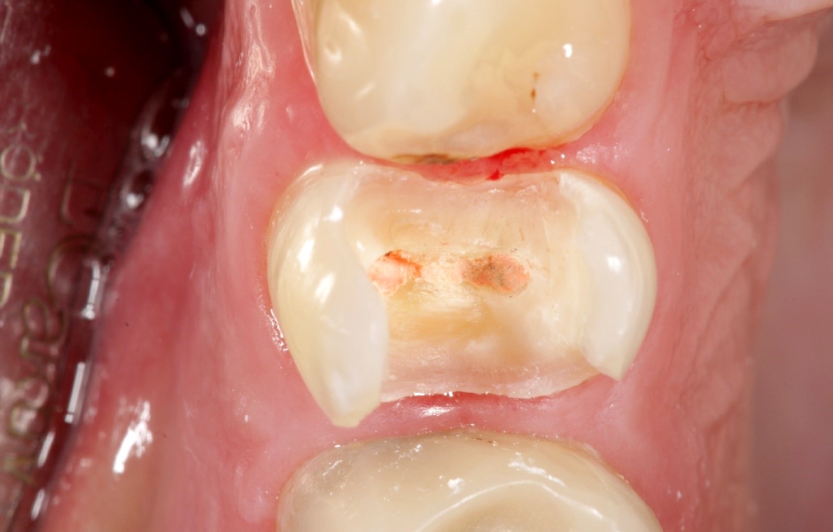 Obr. 6: Zub číslo 15 byl ošetřen endodonticky, rozsáhlá ztráta tvrdých zubních tkání MOD.