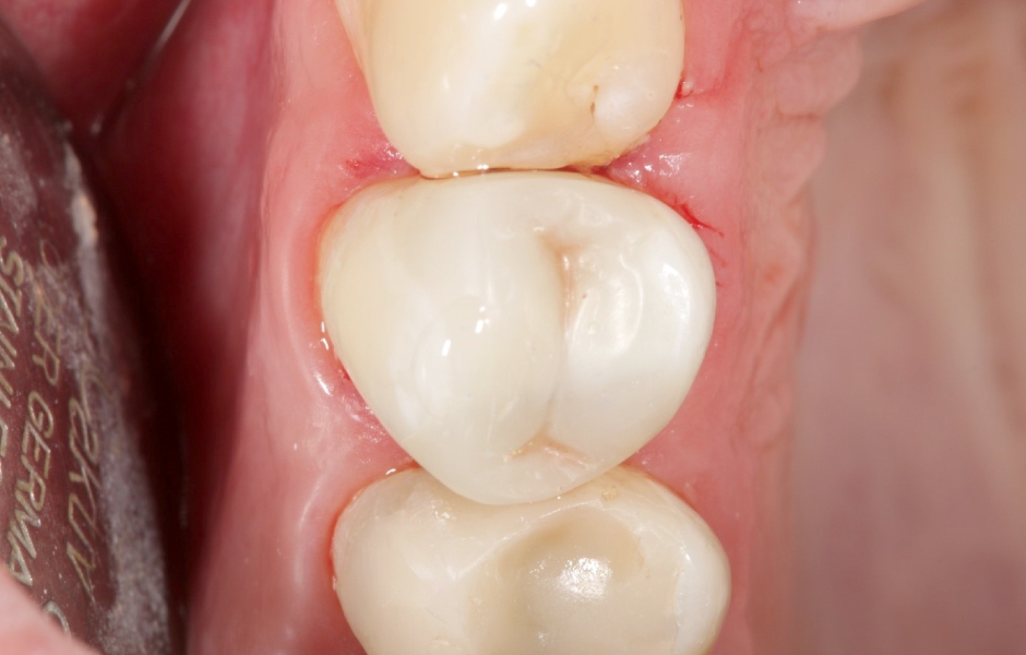 Obr. 8a, b: Zavedení kovové matrice a rekonstrukce klinické korunky zubu 15 fotokompozitním materiálem Tetric Evoceram Bul Fill, odstín B.