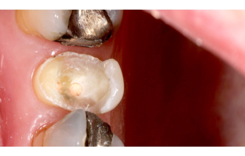 Obr. 9: Zub 25 – rozsáhlý defekt tvrdých zubních tkání klinické korunky zubu MOD, fraktura vestibulární stěny zubu.