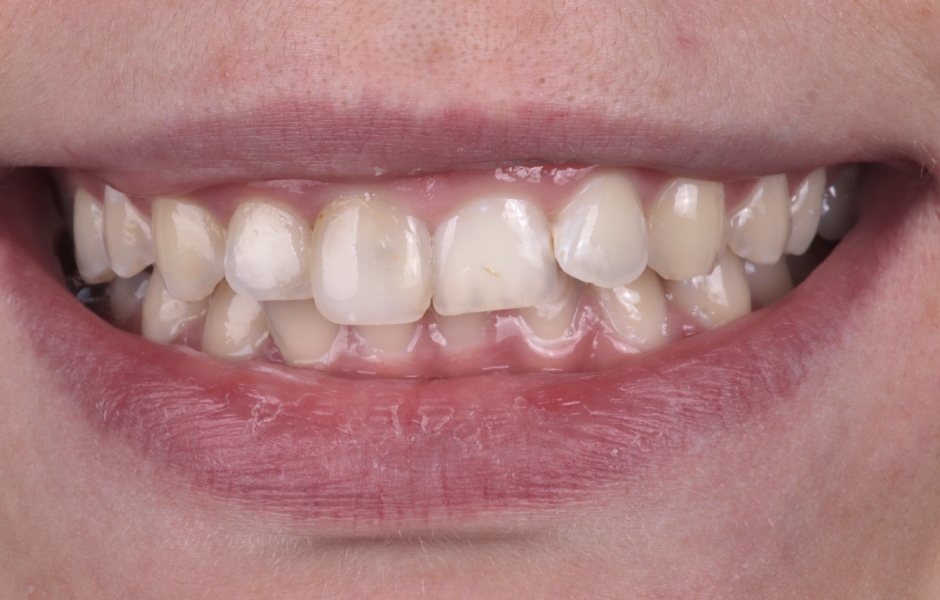 Obr. 1: Výchozí situace – frontální pohled.