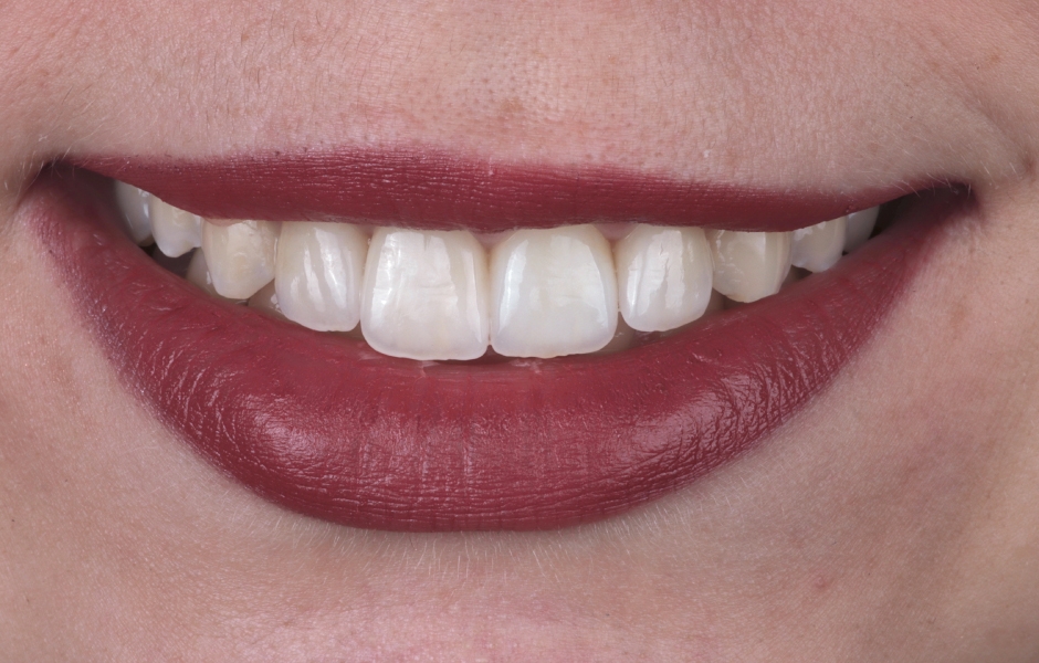 Obr. 11: Pohled na rty po nasazení fazet.