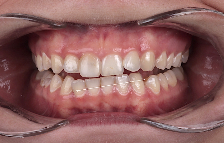 Obr. 4: Detailní pohled znázorňující blokový posun dolních frontálních zubů.