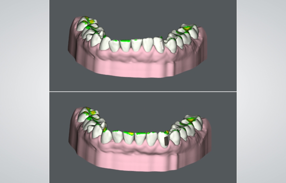 Obr. 5: Plánování alignerové terapie za účelem optimalizace postavení zubů v horní a dolní čelisti.