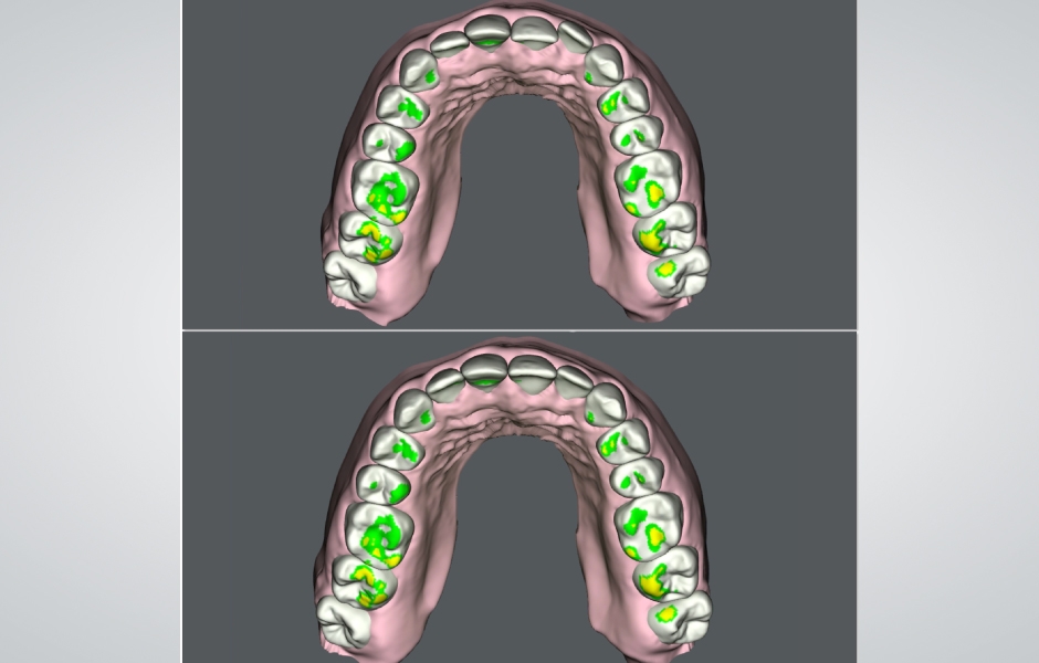 Obr. 6: Plánování alignerové terapie za účelem optimalizace postavení zubů v horní a dolní čelisti.