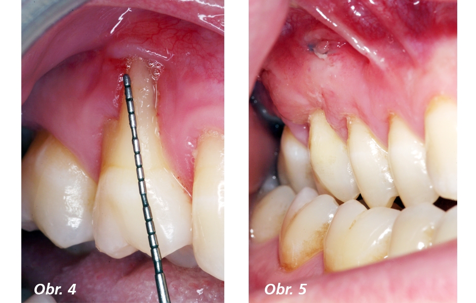 Obr. 4: Před ošetřením – výrazný reces často vede k uvolnění připojené gingivy, které vede k velmi křehké sliznici obklopující zub Obr. 5: Po ošetření
