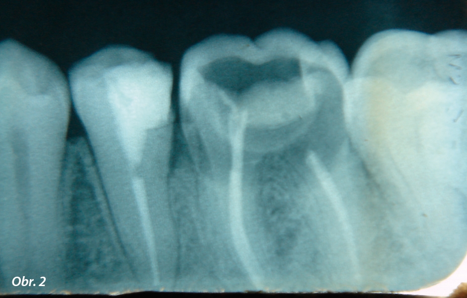 Velká kavita, zub obtížně uchopitelný běžnými kleštěmi