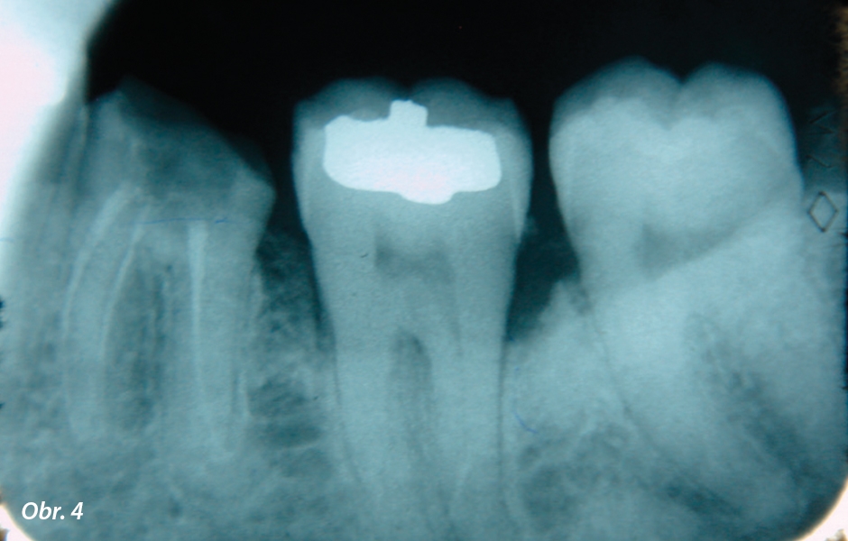 Endodonticky ošetřený zub bez korunky
