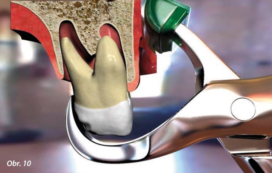 Umístění čelistí kleští na zub (animace)