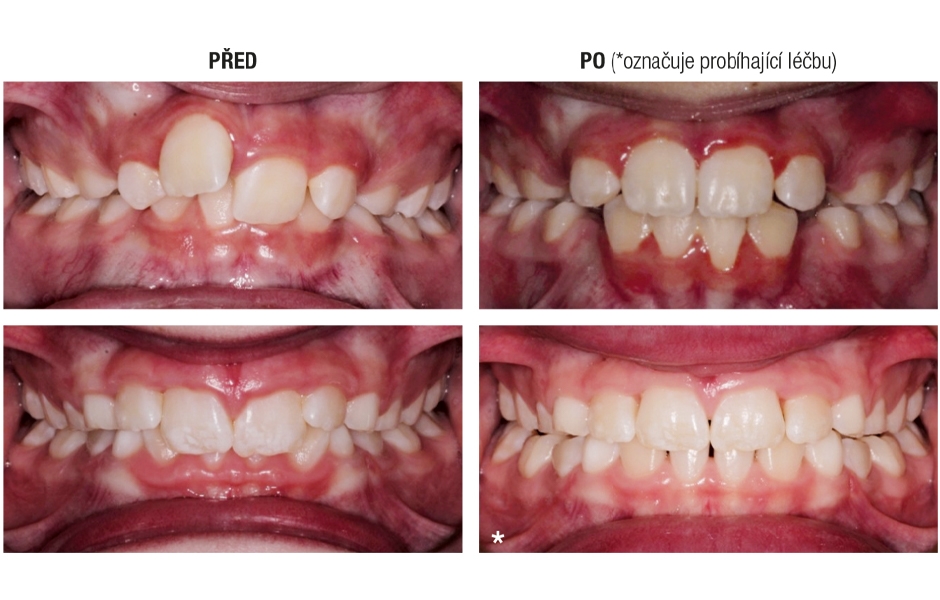 Výhody použití Invisalign First alignerů pro první fázi ortodontické terapie