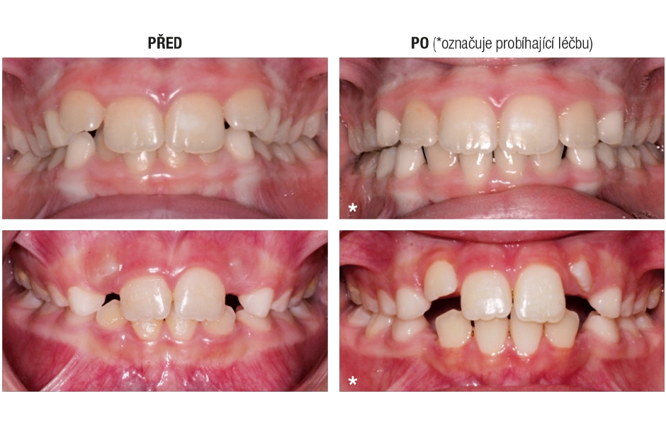 Výhody použití Invisalign First alignerů pro první fázi ortodontické terapie