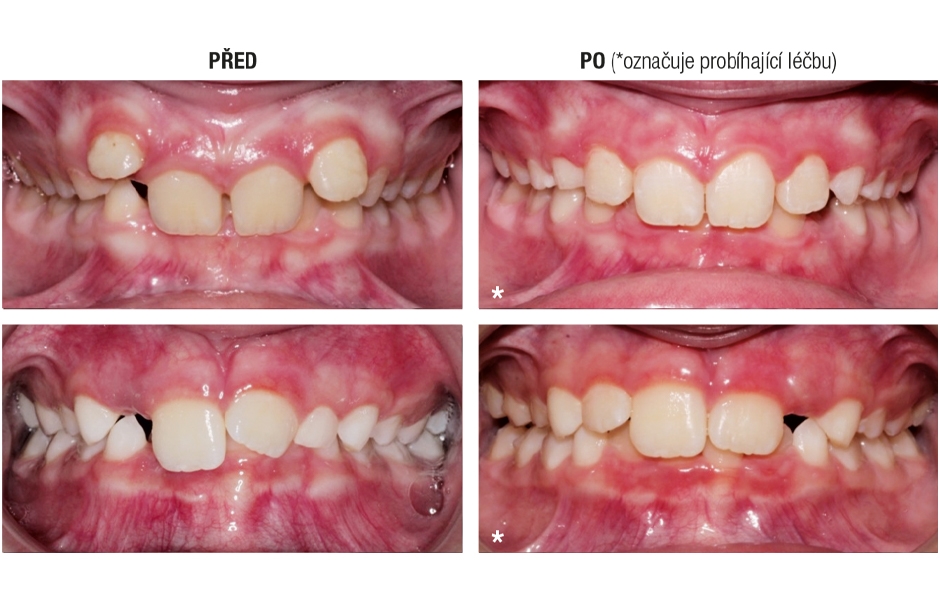 Výhody použití Invisalign First alignerů pro první fázi ortodontické terapie