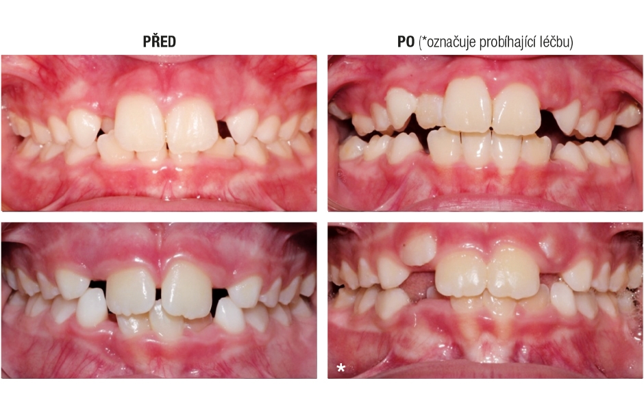 Výhody použití Invisalign First alignerů pro první fázi ortodontické terapie