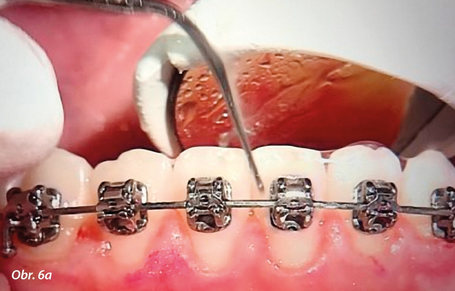 Použití Piezon® PS při odstraňování zubního kamene