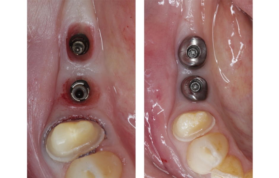 Zirlux 16+ na implantátech.