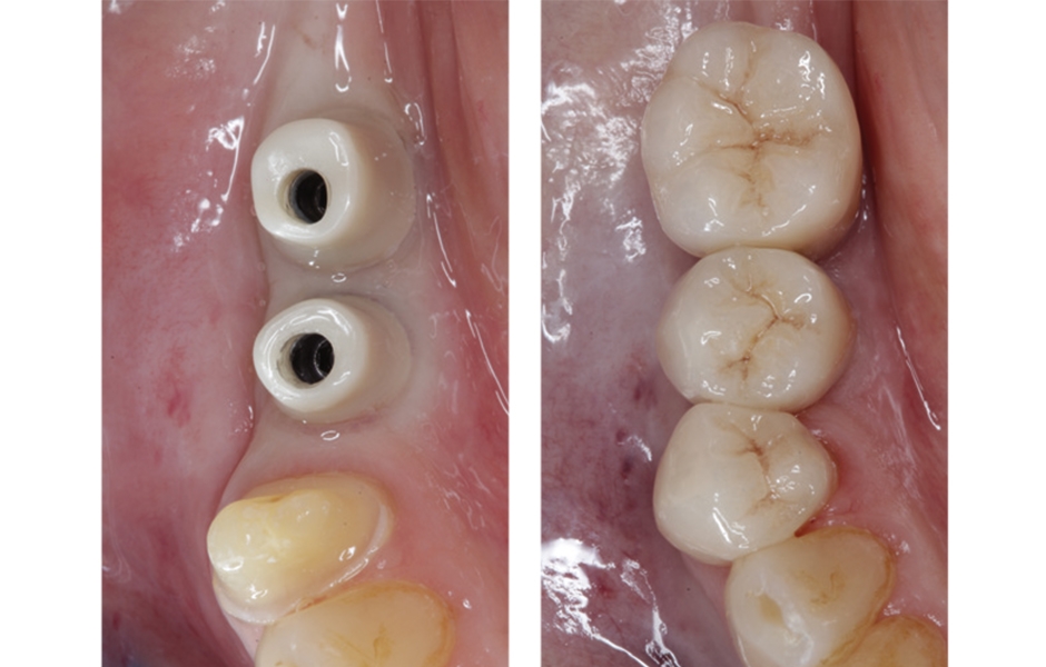 Zirlux 16+ na implantátech.